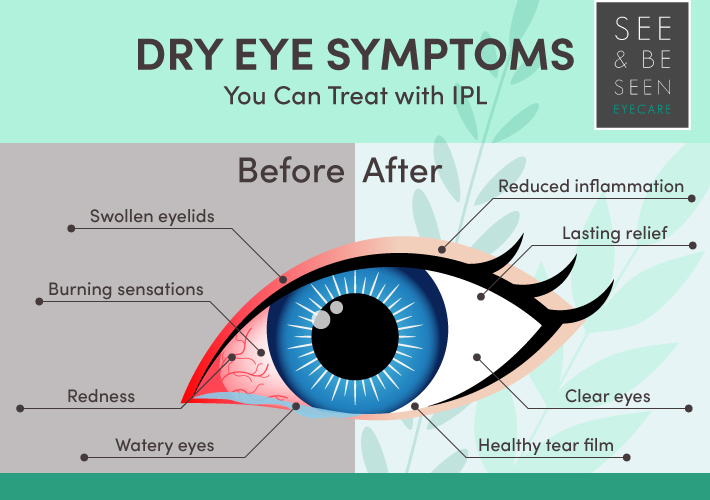 Dry eye care
