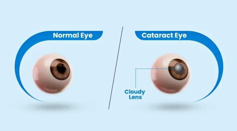 Cataract treatment